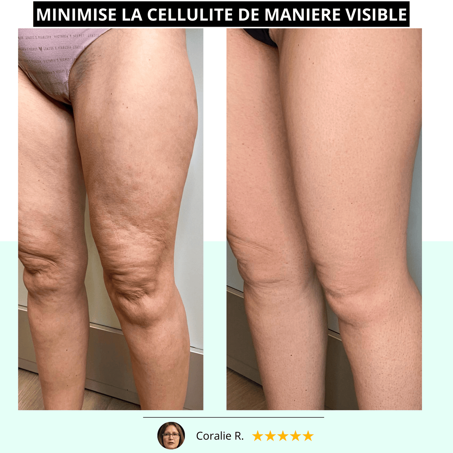 VIBRÉO - Appareil Anti-Cellulite & Brûle-Graisse
